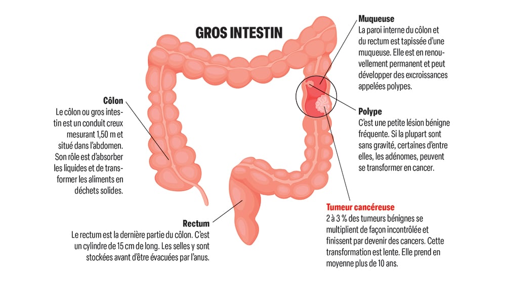 cancer colorectal